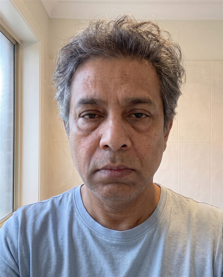 Before: a man's face with bags under his eyes
