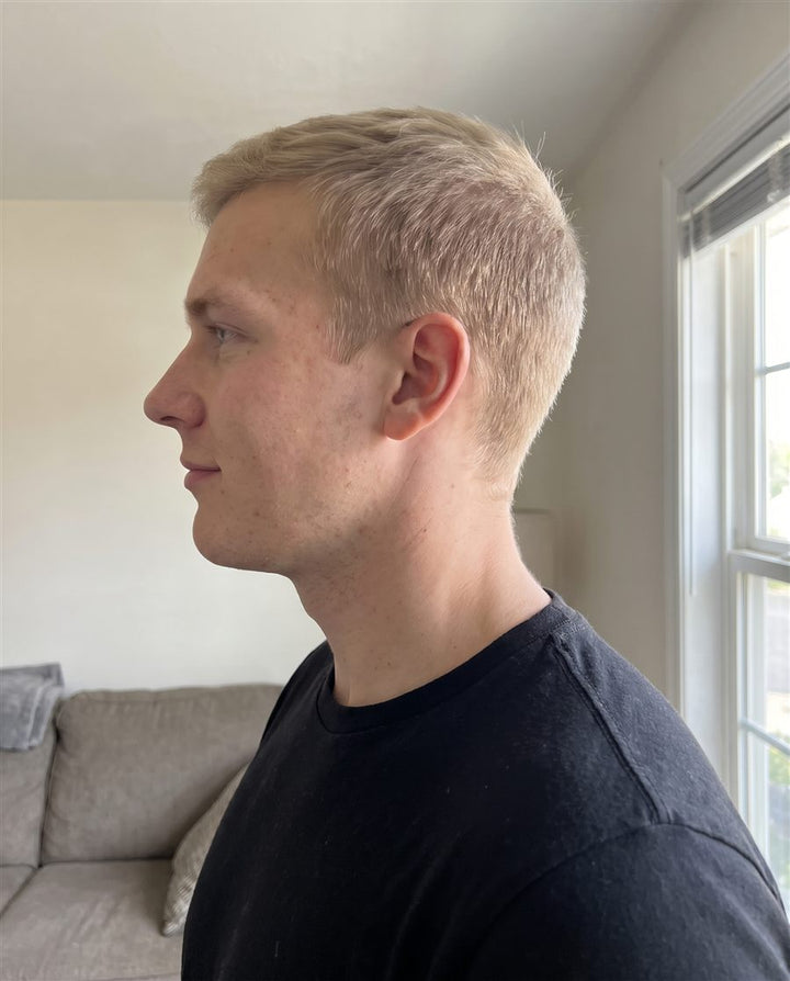 After: side view of a man's jaw and neck