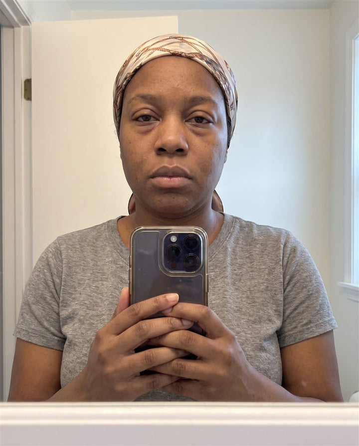 Before: woman in her early 40s, front view, with swelling under the eyes