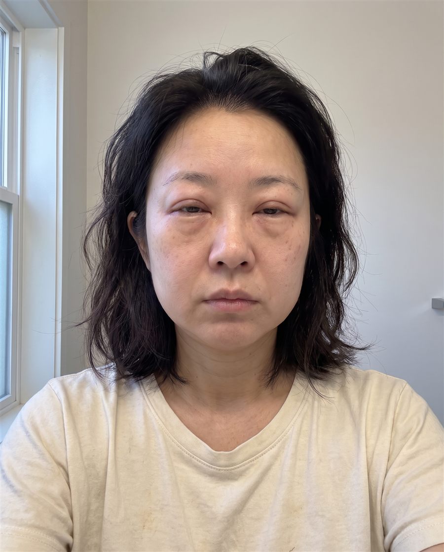 Before: a woman's face with puffy eyelids