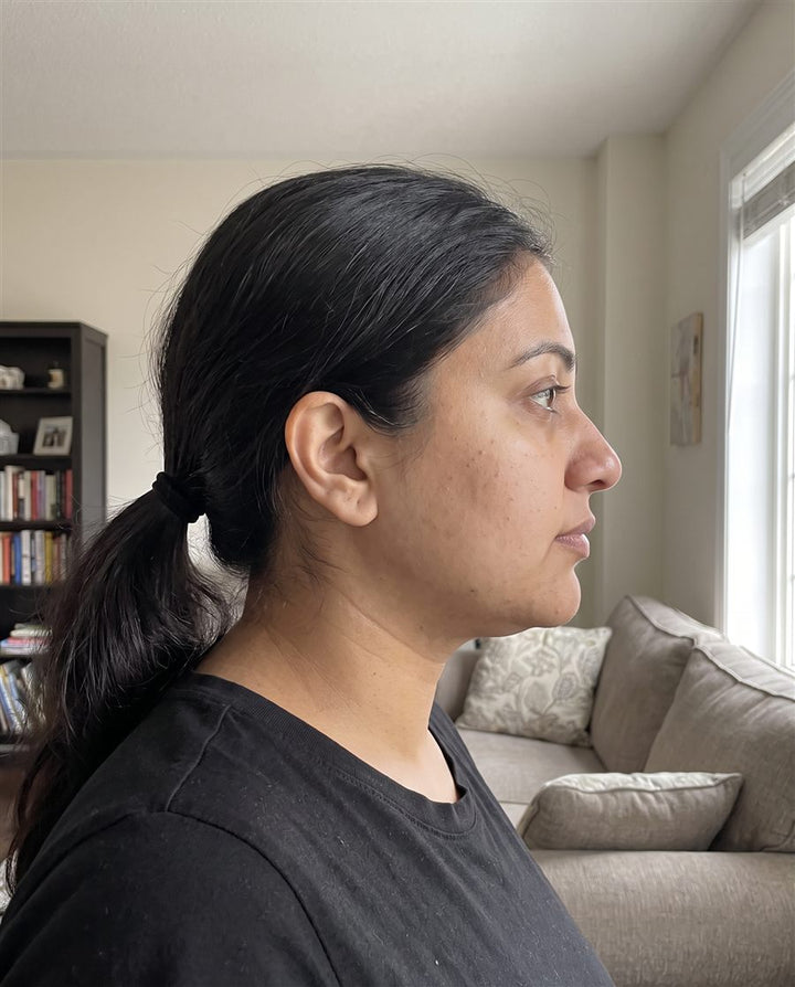 After: side view of the same woman's jaw