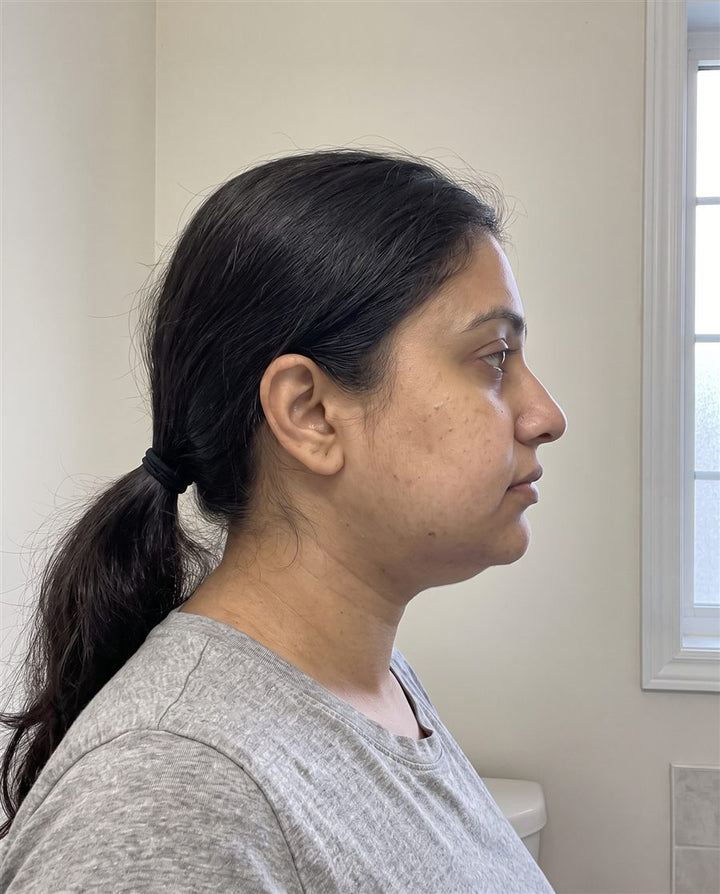 Before: side view of a woman's jaw
